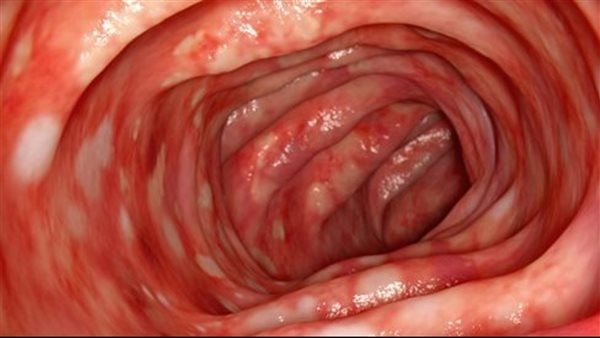 أعراض وأسباب إلتهاب القولون المجهري وأسباب الإصابة به
