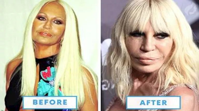 10 صور- نجوم عالميين تغيرت ملامحهم بعد عمليات تجميل من بينهم مادونا وميجان فوكس